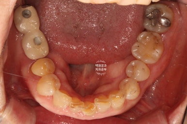 삐뚤빼뚤 앞니 세로 금  - 신경치료 없이 지르코니아 크라운으로. 상악동뼈이식술 임플란트. 관련 이미지 24