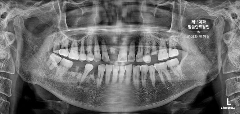 앞니 부러짐? 뽑고 바로 임플란트 + 뼈이식. 앞니 흔들림? 뽑고 1달 기다리고 임플란트 + 뼈이식. 신사역 치과 후기/비용/과정. 관련 이미지 3