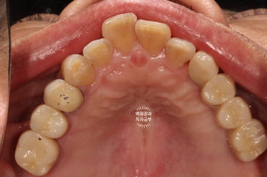 아래 어금니 임플란트 6개면 틀니를 안써도 됩니다.  치주염 전문 착한치과. 치료기간/임시치아과정/후기/비용. 관련 이미지 27