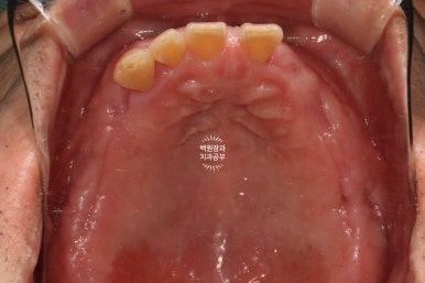임플란트장인의 마음으로 8개월간 전체임플란트 완성. 치주과 전문의. 관련 이미지 17