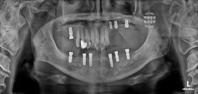 아래 어금니 임플란트 6개면 틀니를 안써도 됩니다.  치주염 전문 착한치과. 치료기간/임시치아과정/후기/비용. 관련 이미지 14