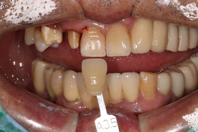 치주염 앞니 잇몸 염증으로 흔들릴 때 - 앞니 브릿지와 임플란트 장단점, 비용. 치료과정과 결과를 눈으로 보여주는 치과. 관련 이미지 11