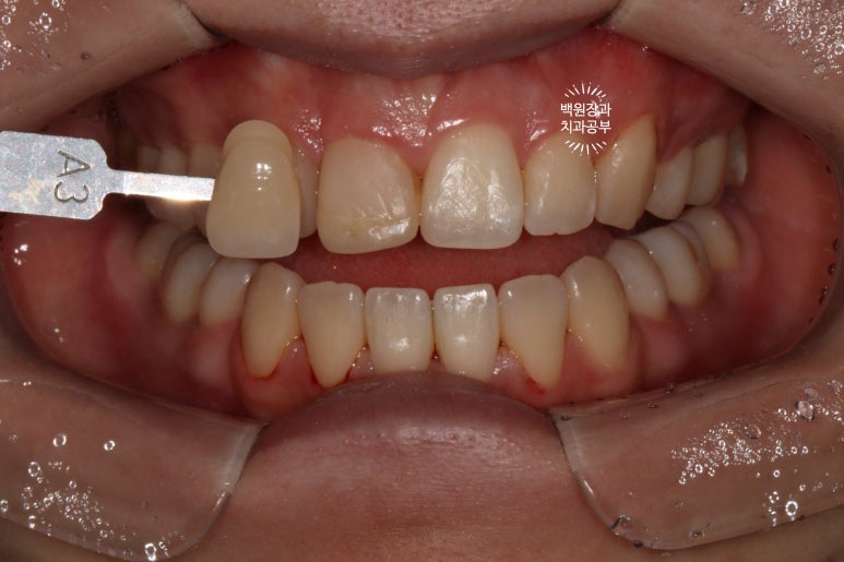 잇몸 성형과 치아미백 그리고 지르코니아 20대 앞니 크라운 치료. 치료과정/기간/비용. 관련 이미지 8
