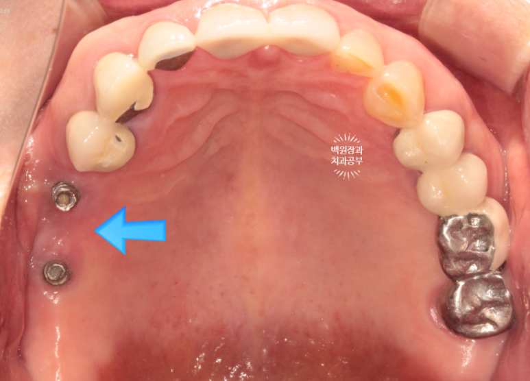 임플란트에서 고름이 나와요. 임플란트 주위염 그리고 재수술을 위한 준비. 치료과정/치료기간/비용/후기. 관련 이미지 13