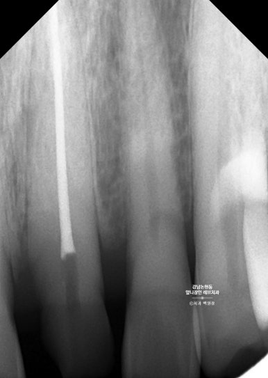 강남논현동치과 60대 치아부러짐 - 신경치료하고 기둥심고 앞니 크라운 잘하는곳! 가격/과정/후기/부작용. 관련 이미지 6