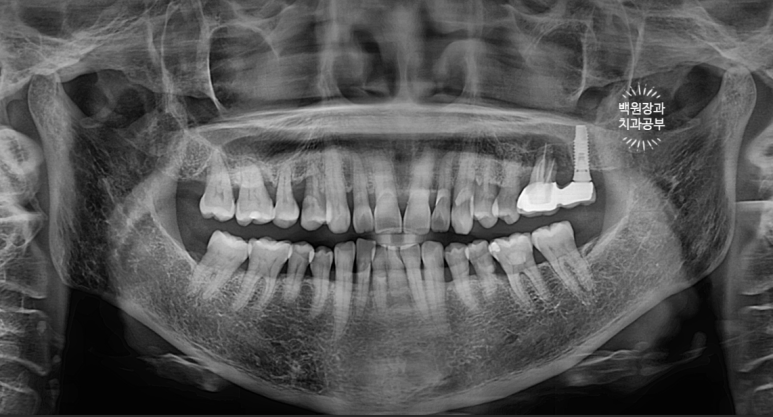 치아와 임플란트를 연결하면 치아가 망가집니다. 발치 동시 치조골 이식 후 임플란트. 치료과정/치료기간/비용/후기. 관련 이미지 5