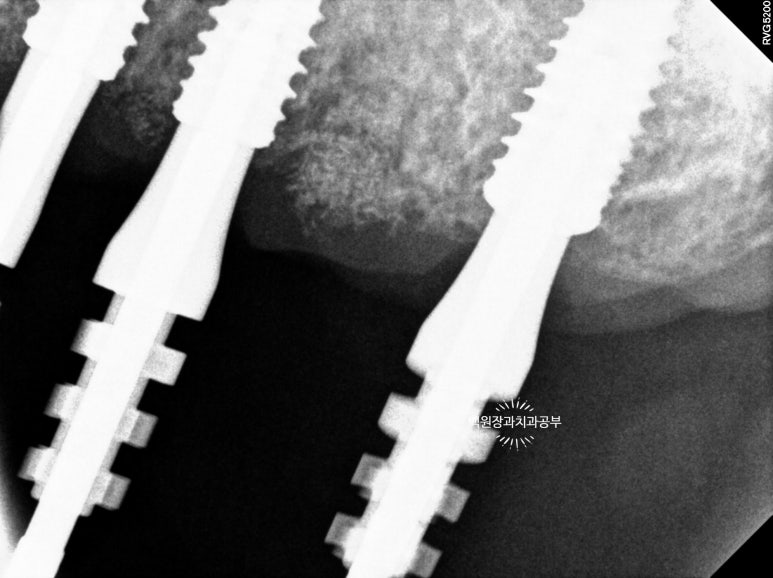 오스템임플란트 네비게이션 전체 임플란트 치료일기. 치료과정/치료기간/비용/솔직후기. 관련 이미지 14