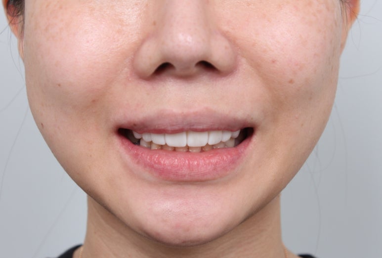 신사역 라미네이트. 결혼식 전 앞니 고민, 얇은 세라믹 레브네이트로 해결! 관련 이미지 20