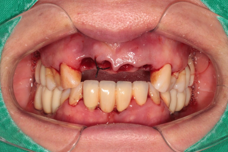 앞니가 풍치로 흔들거려요. 심한 치주염인데 임플란트 가능할까요? 치료과정/치료기간/비용/성공후기. 신금호역 치과 추천. 관련 이미지 7