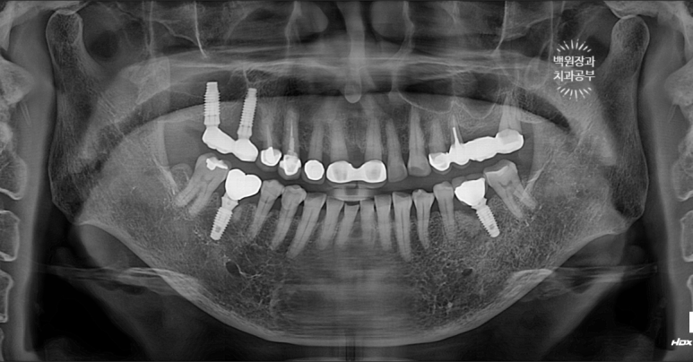 임플란트에서 고름이 나와요. 임플란트 주위염 그리고 재수술을 위한 준비. 치료과정/치료기간/비용/후기. 관련 이미지 11