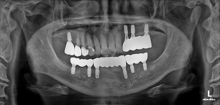 아래 어금니 임플란트 6개면 틀니를 안써도 됩니다.  치주염 전문 착한치과. 치료기간/임시치아과정/후기/비용. 관련 이미지 29