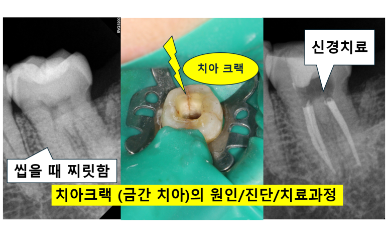 치아크랙 (금간 치아)의 찌릿한 통증 - 발치하지 않고 살려보기. 원인/진단/치료과정/비용/기간. 보존과전문의 치과. 관련 이미지 1