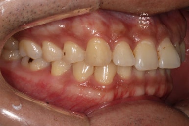 교정 유지장치 근처 앞니 옆면 충치 및 착색 간단히 3M 레진으로 치료. 치료과정/비용/후기. 과잉진료 없는 치과. 관련 이미지 10