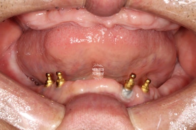 불편한 틀니를 아직도 쓰시나요? 전체 임플란트 치료비용/치료기간/치료과정. 관련 이미지 6