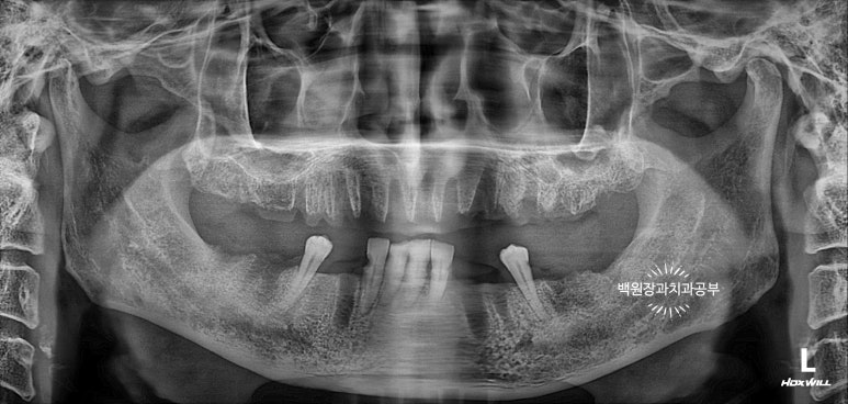 오스템임플란트 네비게이션 전체 임플란트 치료일기. 치료과정/치료기간/비용/솔직후기. 관련 이미지 2