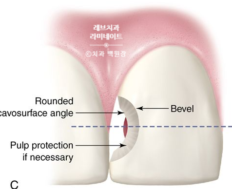 레브네이트 마스터 ; 예비신랑 앞니 무삭제라미네이트. 신사역 치과. 치료후기/비용/가격. 관련 이미지 10