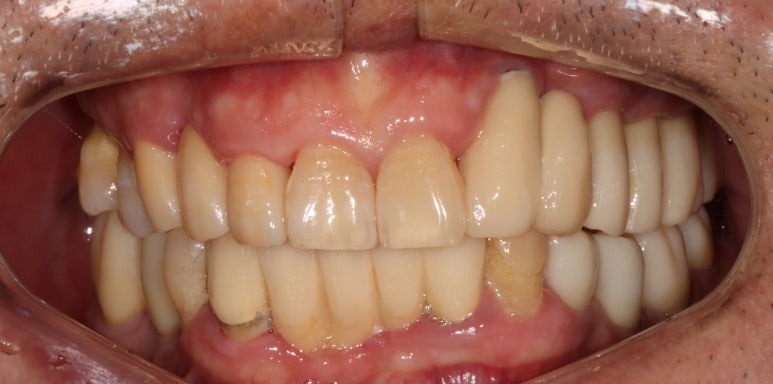 치주염 앞니 잇몸 염증으로 흔들릴 때 - 앞니 브릿지와 임플란트 장단점, 비용. 치료과정과 결과를 눈으로 보여주는 치과. 관련 이미지 13