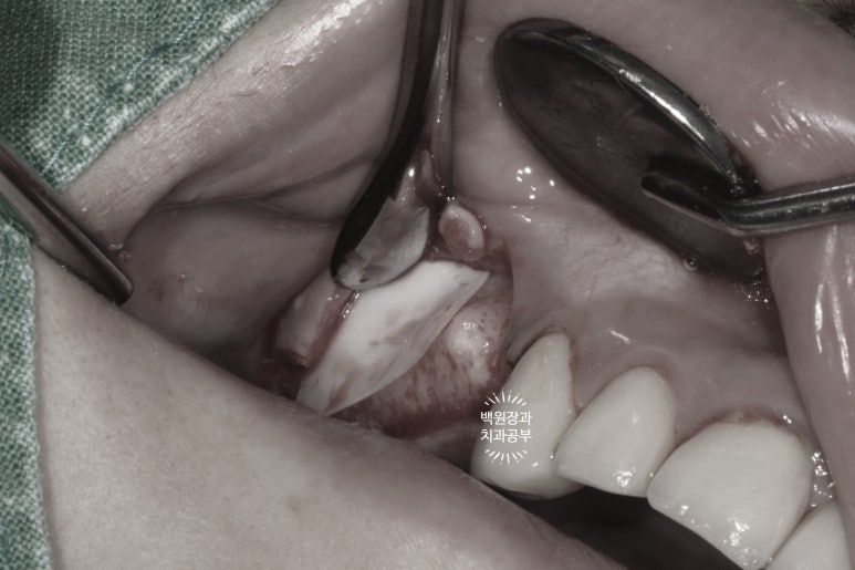 부분틀니 대신 어금니 임플란트를 만들어드립니다. 40대 어금니 상악동 뼈이식 임플란트. 치료기간/비용/과정. 관련 이미지 12