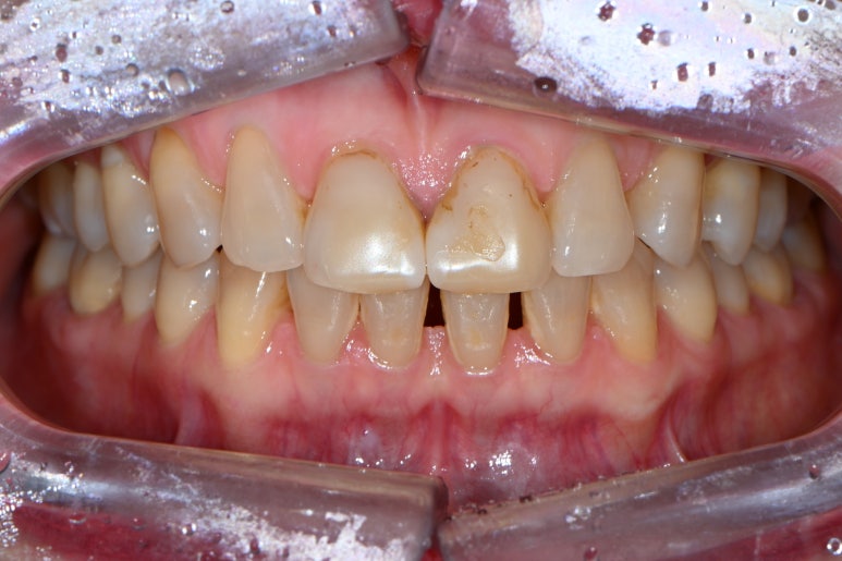 레브네이트 엑스퍼트 - 앞니 무삭제 라미네이트. 40대 벌어진 앞니에 변색된 레진은 이제 그만! 압구정 치과 추천 전후/비용. 관련 이미지 3