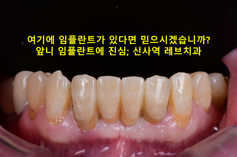 Seoul Sinsa Station [Lev Dental Clinic] For chronic periodontitis, extract the lower front teeth and make the crown look even more real than the real thing with an implant. image 1