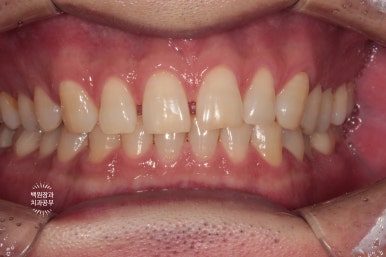 아래 어금니가 없어 위 어금니가 내려왔어요. 부분 교정을 곁들인 스트라우만 임플란트 수술. 억울한 신경치료를 피해보자. 치료과정/치료기간/비용/후기. 관련 이미지 14