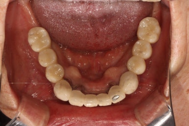 부분틀니를 오래써서 어금니가 아플 때, 아래턱 양쪽 어금니 임플란트 잘하는 강남임플란트치과 관련 이미지 32