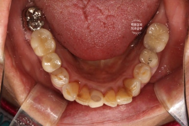 스트라우만 임플란트로 이뽑고 바로심는치과 - 믿고 사용하는 세계 1위 스위스 임플란트 회사. 관련 이미지 36