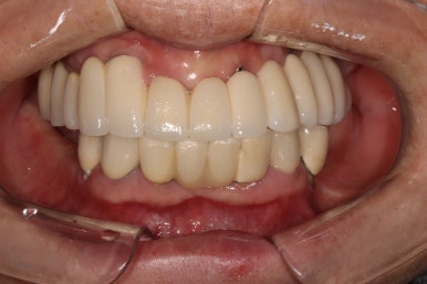 부분틀니를 오래써서 어금니가 아플 때, 아래턱 양쪽 어금니 임플란트 잘하는 강남임플란트치과 관련 이미지 35