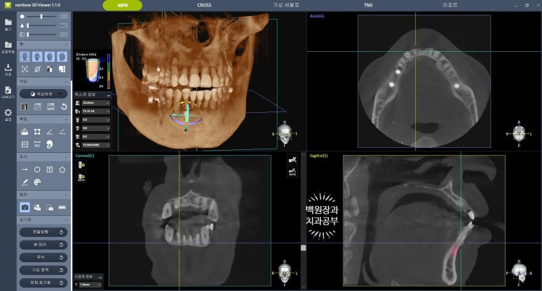 Seoul Sinsa Station [Lev Dental Clinic] For chronic periodontitis, extract the lower front teeth and make the crown look even more real than the real thing with an implant. image 4