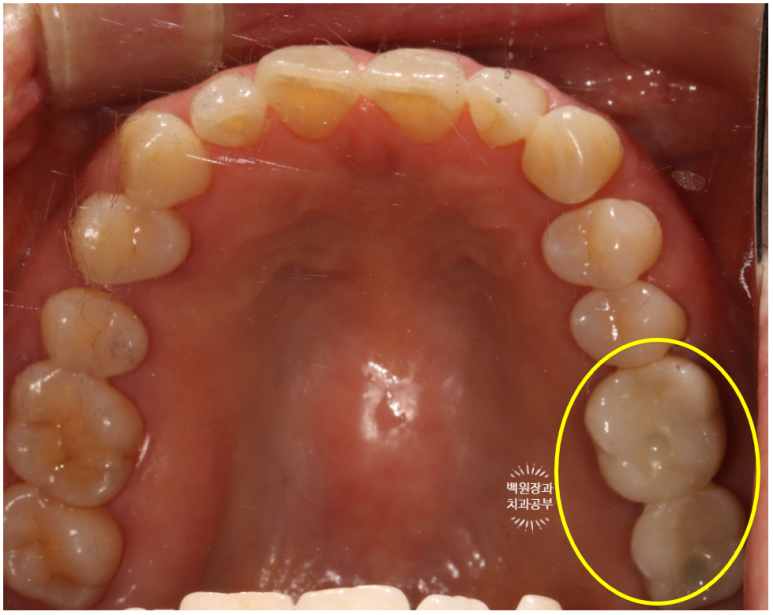 치아와 임플란트를 연결하면 치아가 망가집니다. 발치 동시 치조골 이식 후 임플란트. 치료과정/치료기간/비용/후기. 관련 이미지 16