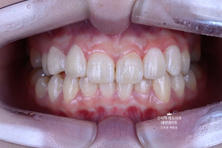 신사역 치과. 아나운서 면접 전 앞니 벌어진 공간을 라미네이트로만 해결할 수 있었던 사연.. 관련 이미지 24