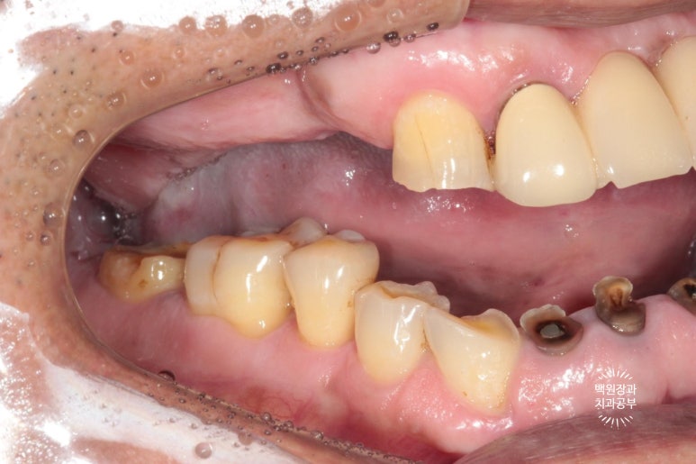 뿌리만 남은 앞니, 어금니가 없어 교합이 무너진 증례. 흡연자의 전체 오스템BA임플란트 재건증례. 치료과정/치료기간/비용/후기. 관련 이미지 4