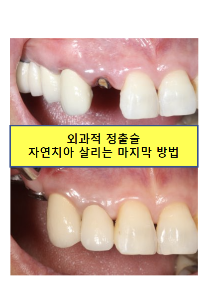 외과적 정출술 (surgical extrusion) - 치아를 살리는 마지막 방법. 치료과정/치료기간/비용/사진. 관련 이미지 1