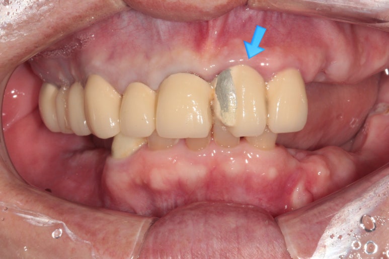 어금니 여러개가 없어요. 전체 임플란트와 앞니 크라운을 통한 완벽한 재건!! 치료과정/치료기간/비용/후기. 관련 이미지 32