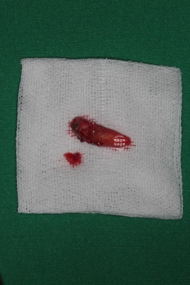 앞니 머리가 기둥째 부러졌어요. 발치 동시 뼈이식 오스템 BA 임플란트. 치료과정/치료기간/비용/후기. 압구정 치과. 관련 이미지 6