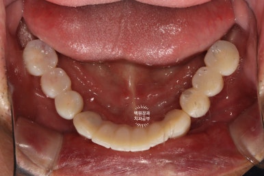 아래 어금니 임플란트 6개면 틀니를 안써도 됩니다.  치주염 전문 착한치과. 치료기간/임시치아과정/후기/비용. 관련 이미지 20