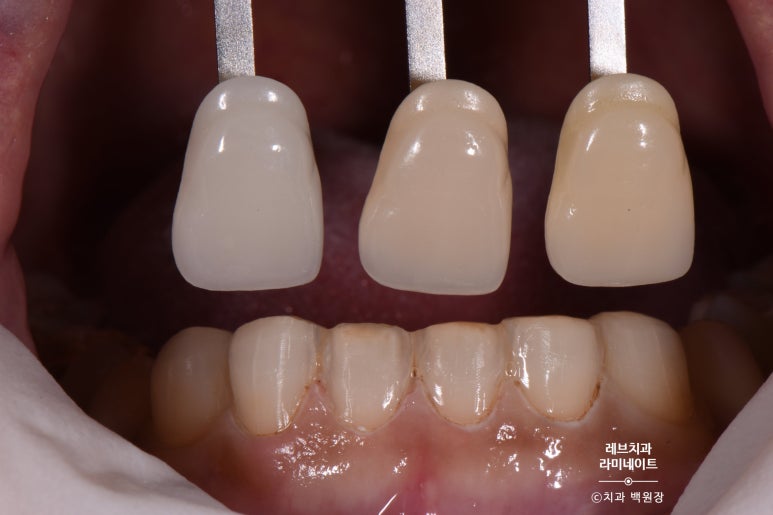 아래앞니 라미네이트도 무삭제로 가능한가요? 레브네이트 베이직 가격/비용/후기/추천. 관련 이미지 9