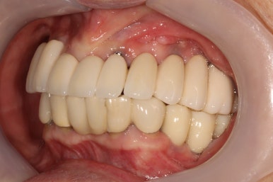 부분틀니를 오래써서 어금니가 아플 때, 아래턱 양쪽 어금니 임플란트 잘하는 강남임플란트치과 관련 이미지 30