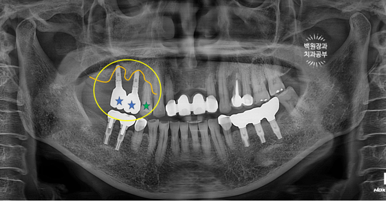 60대 임플란트 주변에서 고름이 나와요. 실패한 임플란트 제거 후 재수술. 덴티움 뼈이식재를 사용한 치조골 이식술. 관련 이미지 2