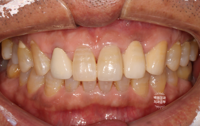 치아와 임플란트를 연결하면 치아가 망가집니다. 발치 동시 치조골 이식 후 임플란트. 치료과정/치료기간/비용/후기. 관련 이미지 4