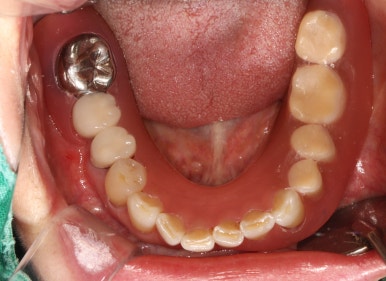 어금니 임플란트 주변 잇몸이식수술 - 저는 해야한다고 생각합니다. (feat. 대한치과의사협회 논문 + 치주과전문) 관련 이미지 10