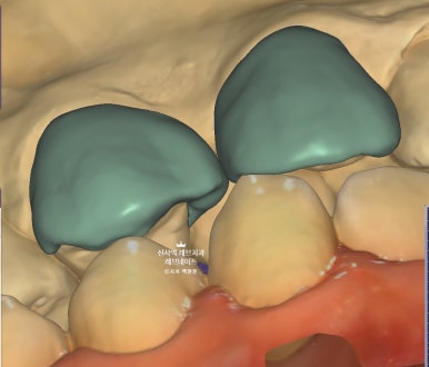 신사역 치과. 아나운서 면접 전 앞니 벌어진 공간을 라미네이트로만 해결할 수 있었던 사연.. 관련 이미지 16