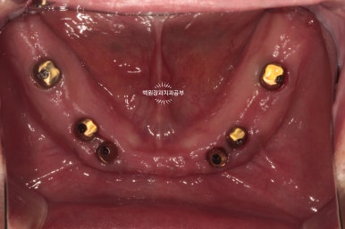 오스템임플란트 네비게이션 전체 임플란트 치료일기. 치료과정/치료기간/비용/솔직후기. 관련 이미지 30