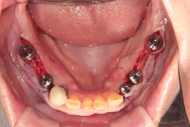 어금니 여러개가 없어요. 전체 임플란트와 앞니 크라운을 통한 완벽한 재건!! 치료과정/치료기간/비용/후기. 관련 이미지 11