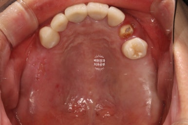 부분틀니 대신 어금니 임플란트를 만들어드립니다. 40대 어금니 상악동 뼈이식 임플란트. 치료기간/비용/과정. 관련 이미지 25