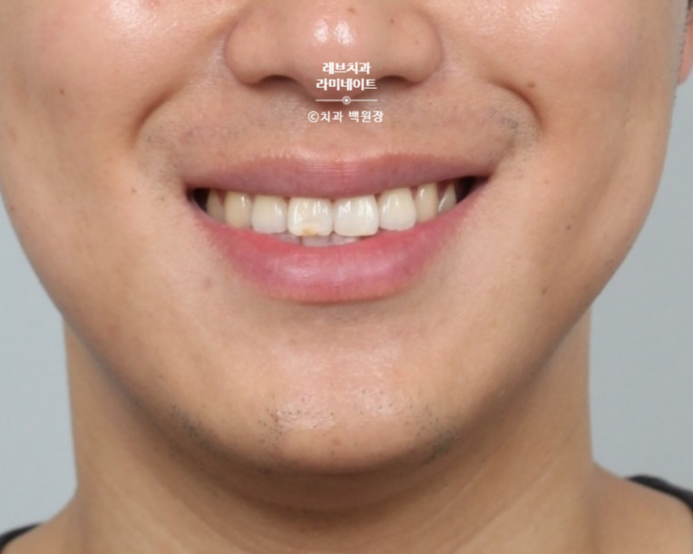 레브네이트 마스터 ; 예비신랑 앞니 무삭제라미네이트. 신사역 치과. 치료후기/비용/가격. 관련 이미지 8