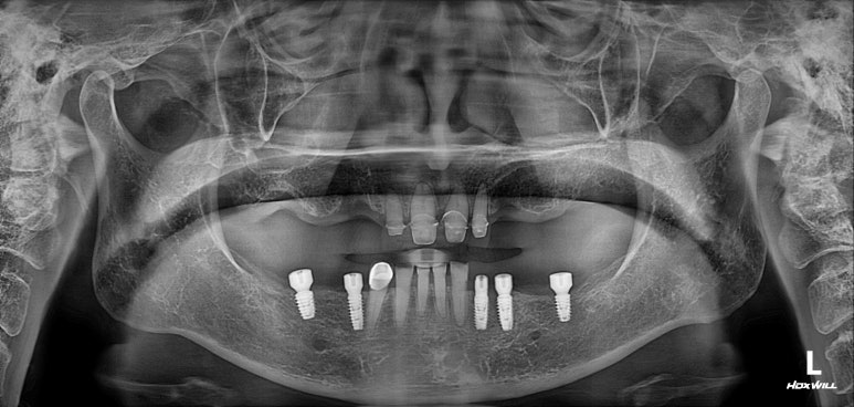 어금니 여러개가 없어요. 전체 임플란트와 앞니 크라운을 통한 완벽한 재건!! 치료과정/치료기간/비용/후기. 관련 이미지 10