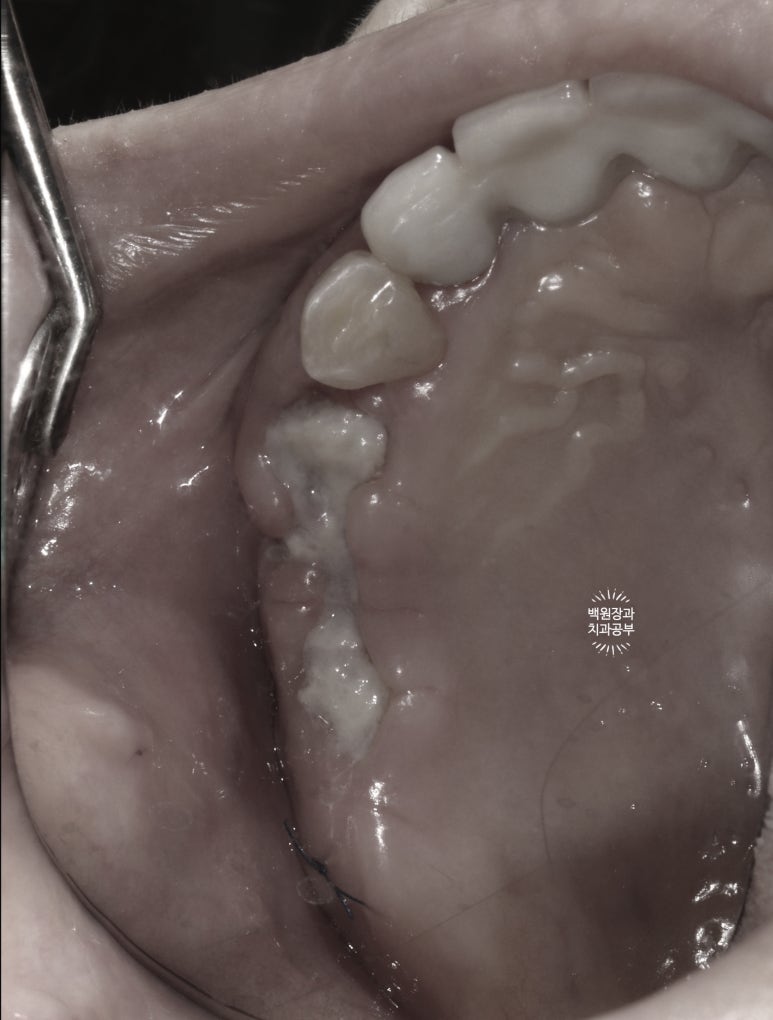 60대 임플란트 주변에서 고름이 나와요. 실패한 임플란트 제거 후 재수술. 덴티움 뼈이식재를 사용한 치조골 이식술. 관련 이미지 8