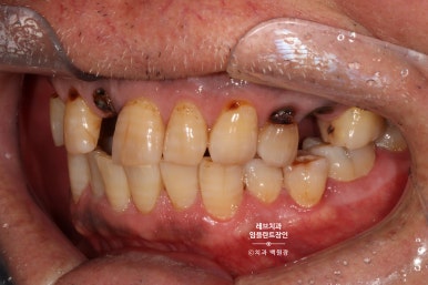 앞니 부러짐? 뽑고 바로 임플란트 + 뼈이식. 앞니 흔들림? 뽑고 1달 기다리고 임플란트 + 뼈이식. 신사역 치과 후기/비용/과정. 관련 이미지 5