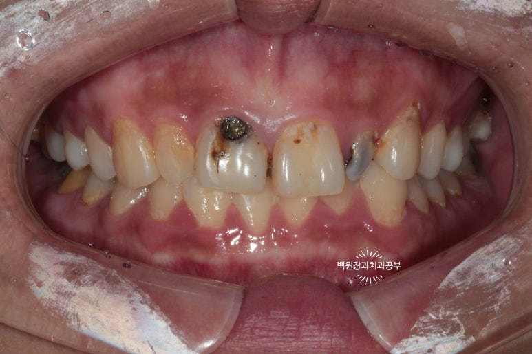앞니에 잇몸염증과 충치가 심해요. 앞니 지르코니아 크라운 성공 후기. 치료과정/치료기간/비용/전후비교. 관련 이미지 2